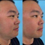 Side-by-side view of a person before and after a cosmetic procedure, showing a refined jawline.