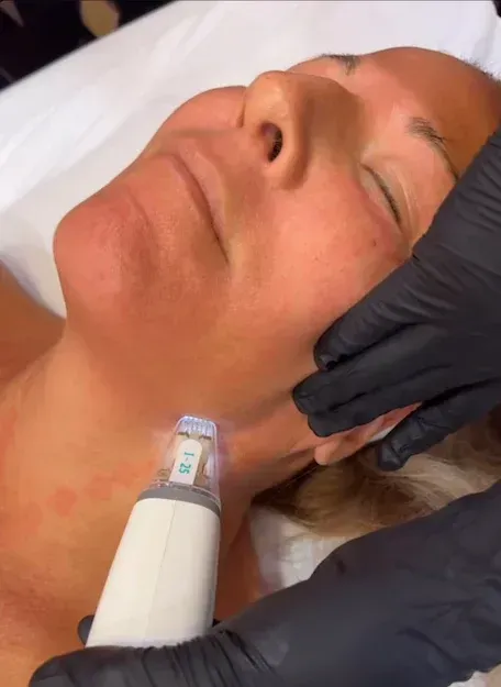 A person receiving a skin treatment on their neck, with device in hand, black gloves, and red skin.