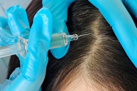 Person's scalp being injected with a syringe by a gloved hand. Close-up, hair visible, treatment underway.