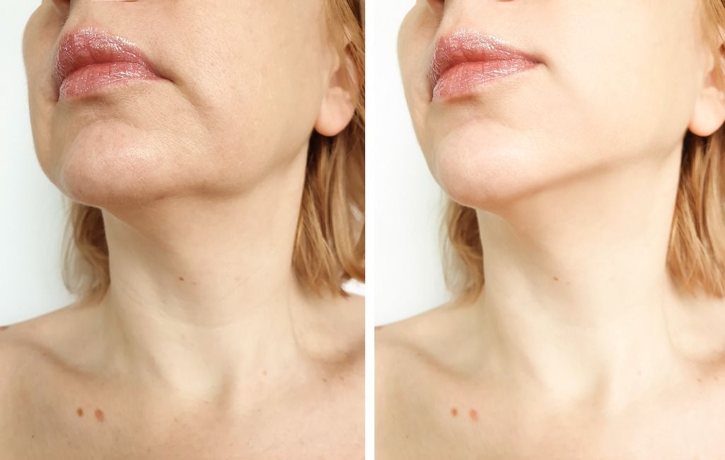 Side-by-side comparison of a person's neck and jaw before and after a cosmetic procedure, showing reduced wrinkles.