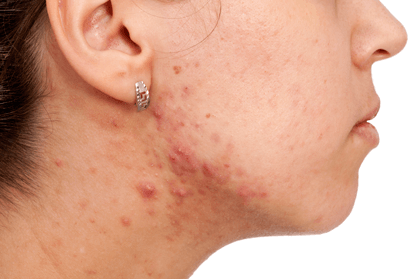 Dr Flora Skin Health  Acne Treatment