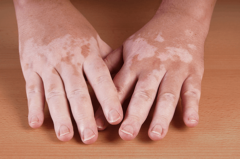 Dr Flora Skin Health  Vitiligo Treatment