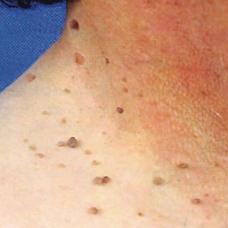 Dr Flora Skin Health  Skin Tags Treatment