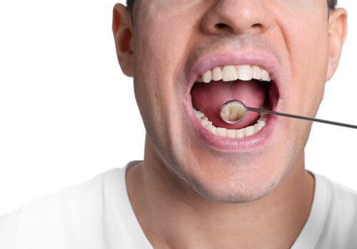 Close-up of a person with mouth open while a cotton swab is inspecting the tongue.
