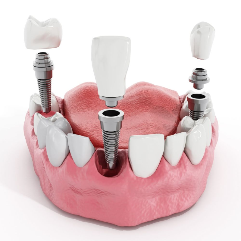 Hands adjusting a dental model with tools in a clinic workspace