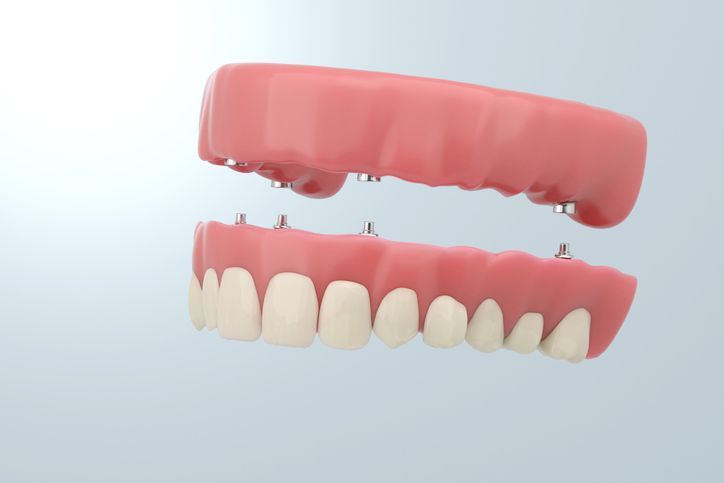 Illustration of upper and lower pink dentures with white teeth, shown slightly open on a light background
