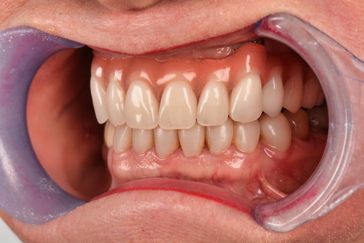 Hands adjusting a dental model with tools in a clinic workspace