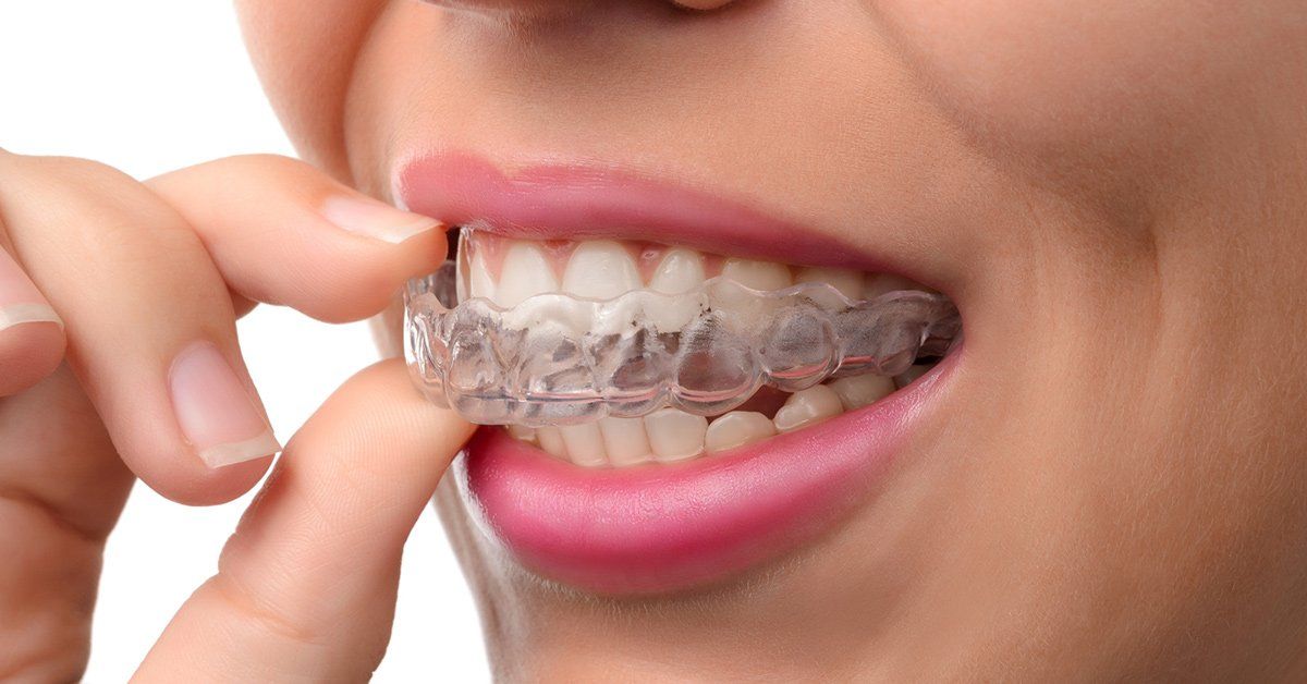 How Do Invisalign® Aligners Work ?, Invisalign Treatment Process