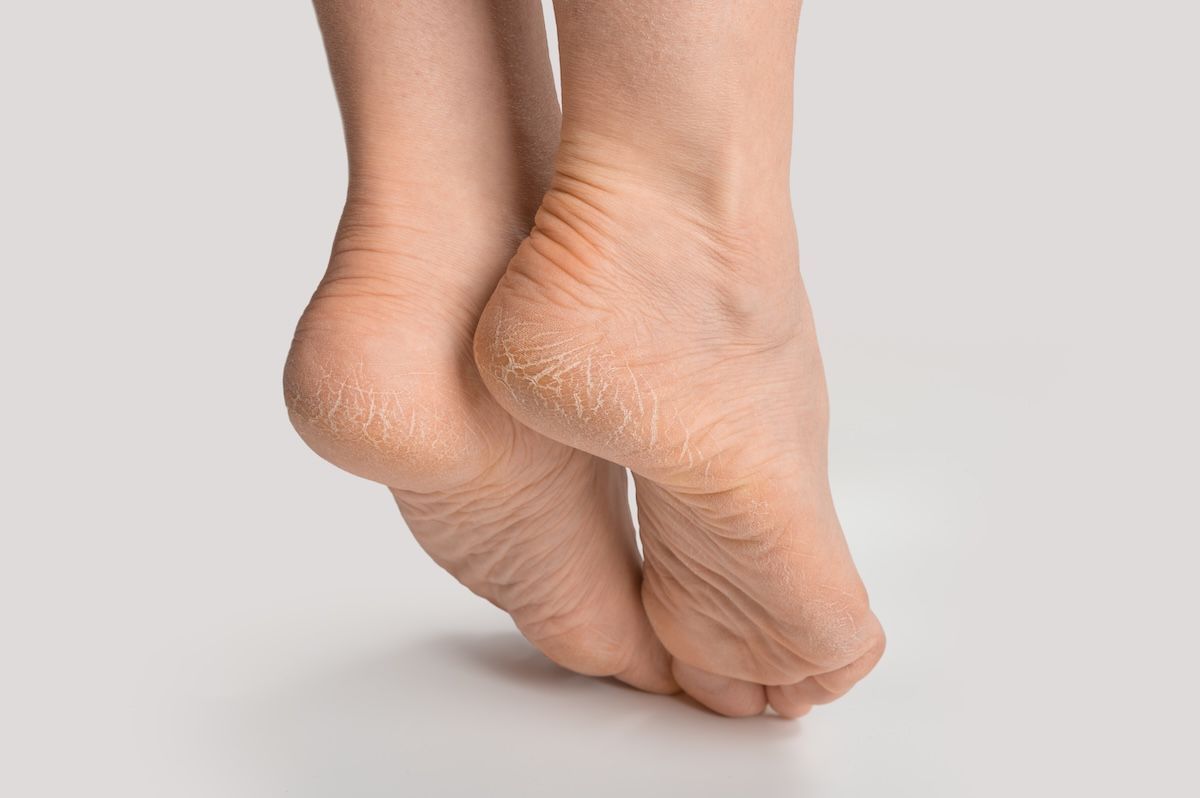 What’s Causing Your Heel Pain?