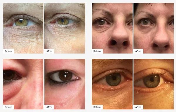 Eye-V™ Hydrogel Patches — Corona, CA — Vikki & John Downey
