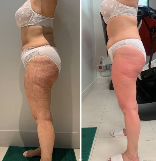 An Artemis T-Shape 2 before and after photo of a woman's midsection and legs.