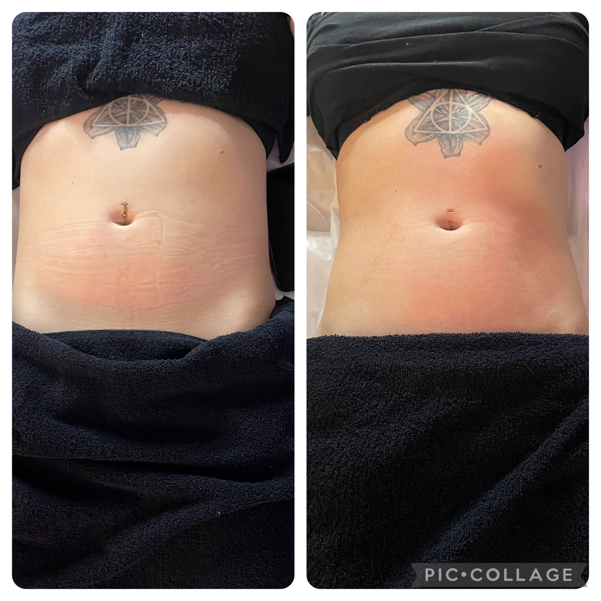 An Artemis T-Shape 2 before and after of a woman's belly.