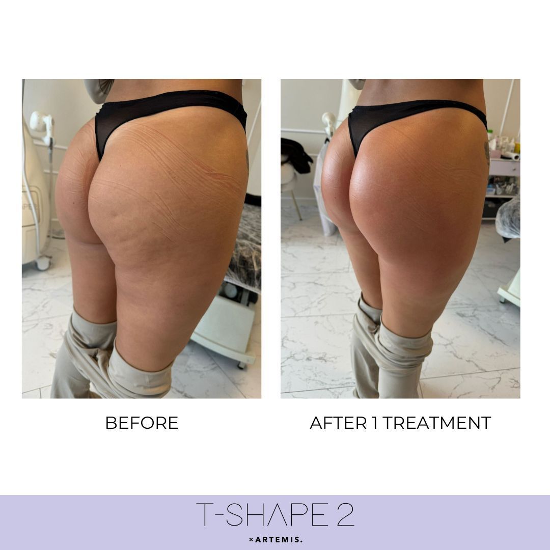 An Artemis T-Shape 2 before and after of a woman's buttocks.