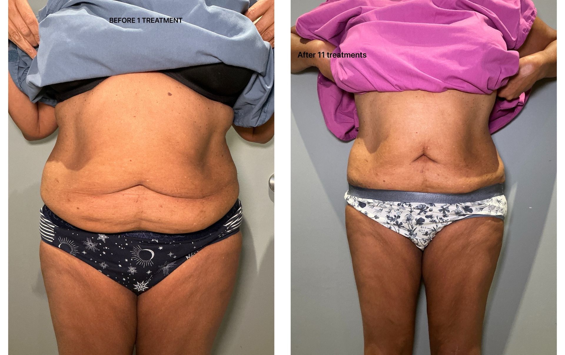 An Artemis T-Shape 2 before and after of a woman's belly.
