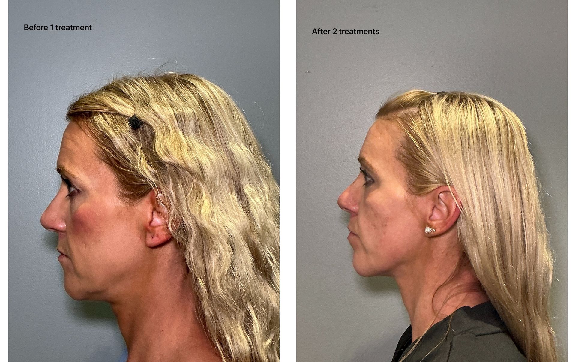 An Artemis T-Shape 2 before and after of a woman's face.