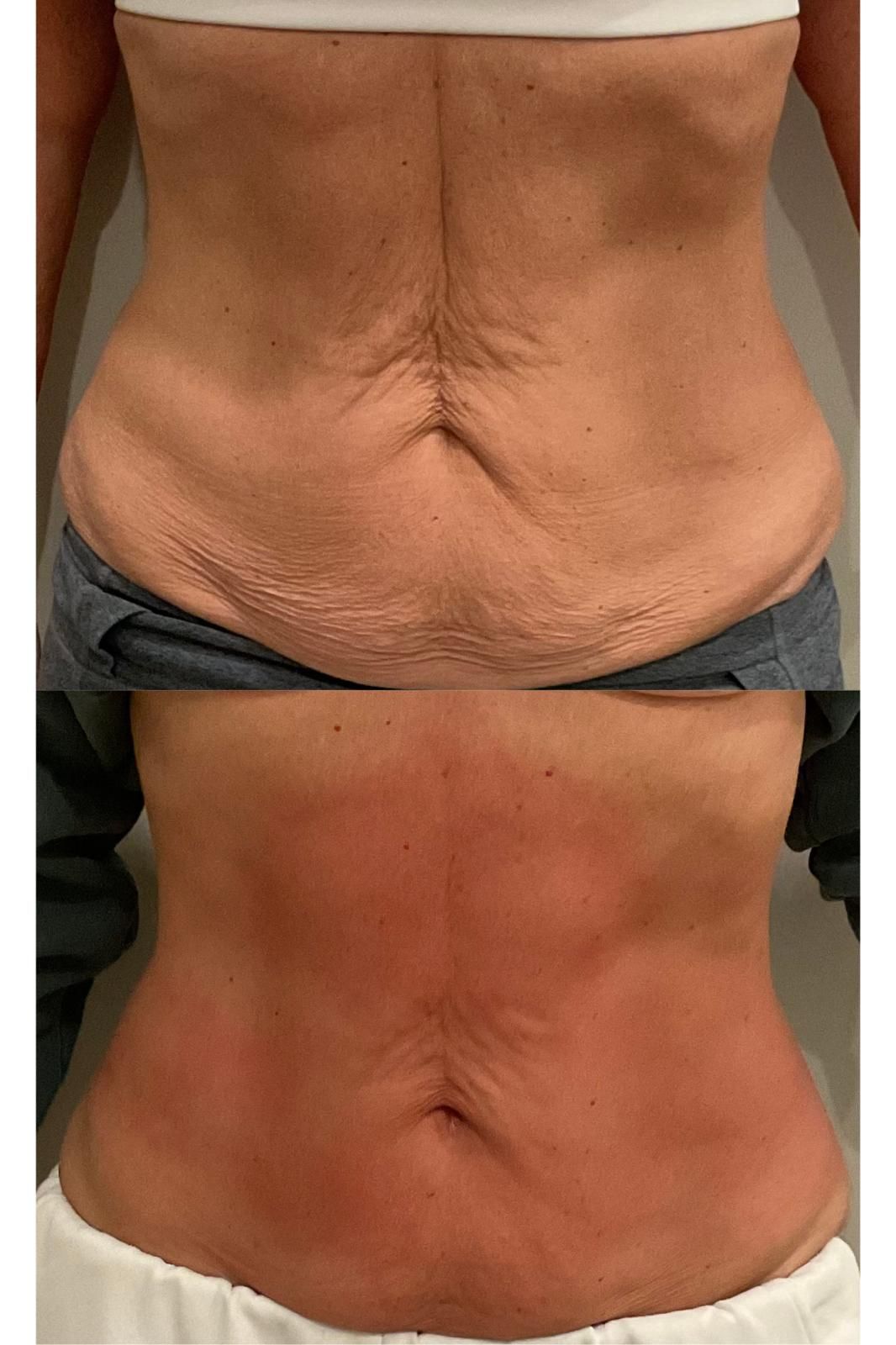 An Artemis T-Shape 2 before and after of a woman's belly.