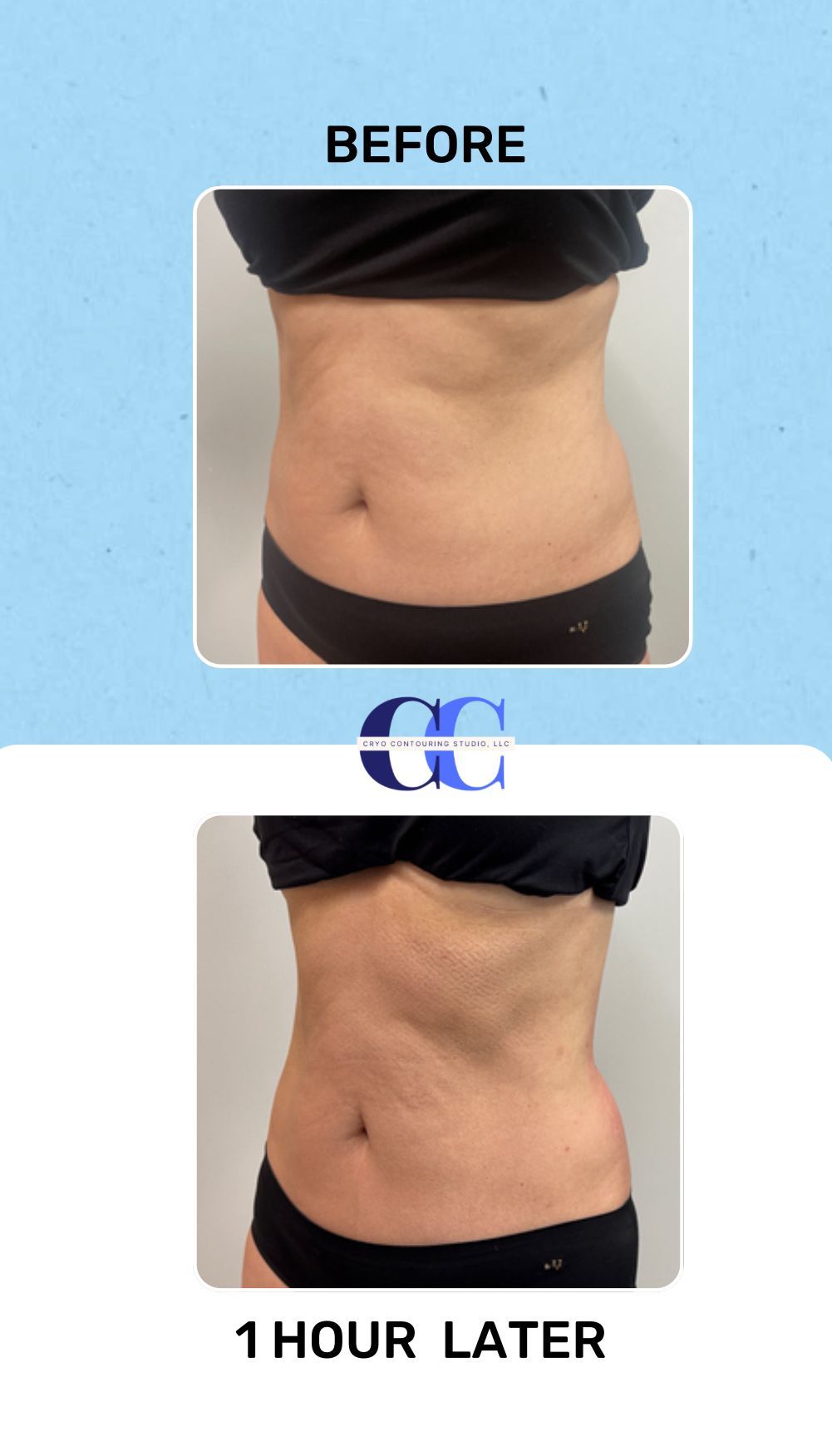 An Artemis T-Shape 2 before and after of a woman's midsection.