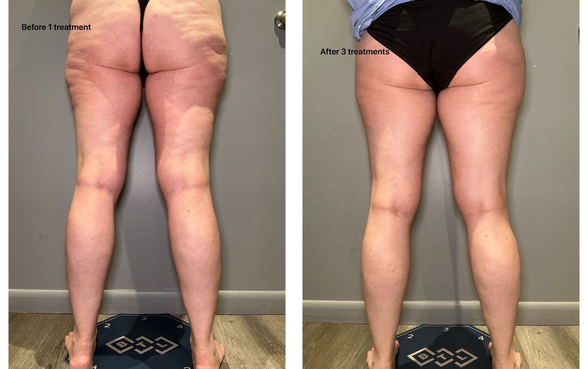 An Artemis T-Shape 2 before and after of a woman's legs.