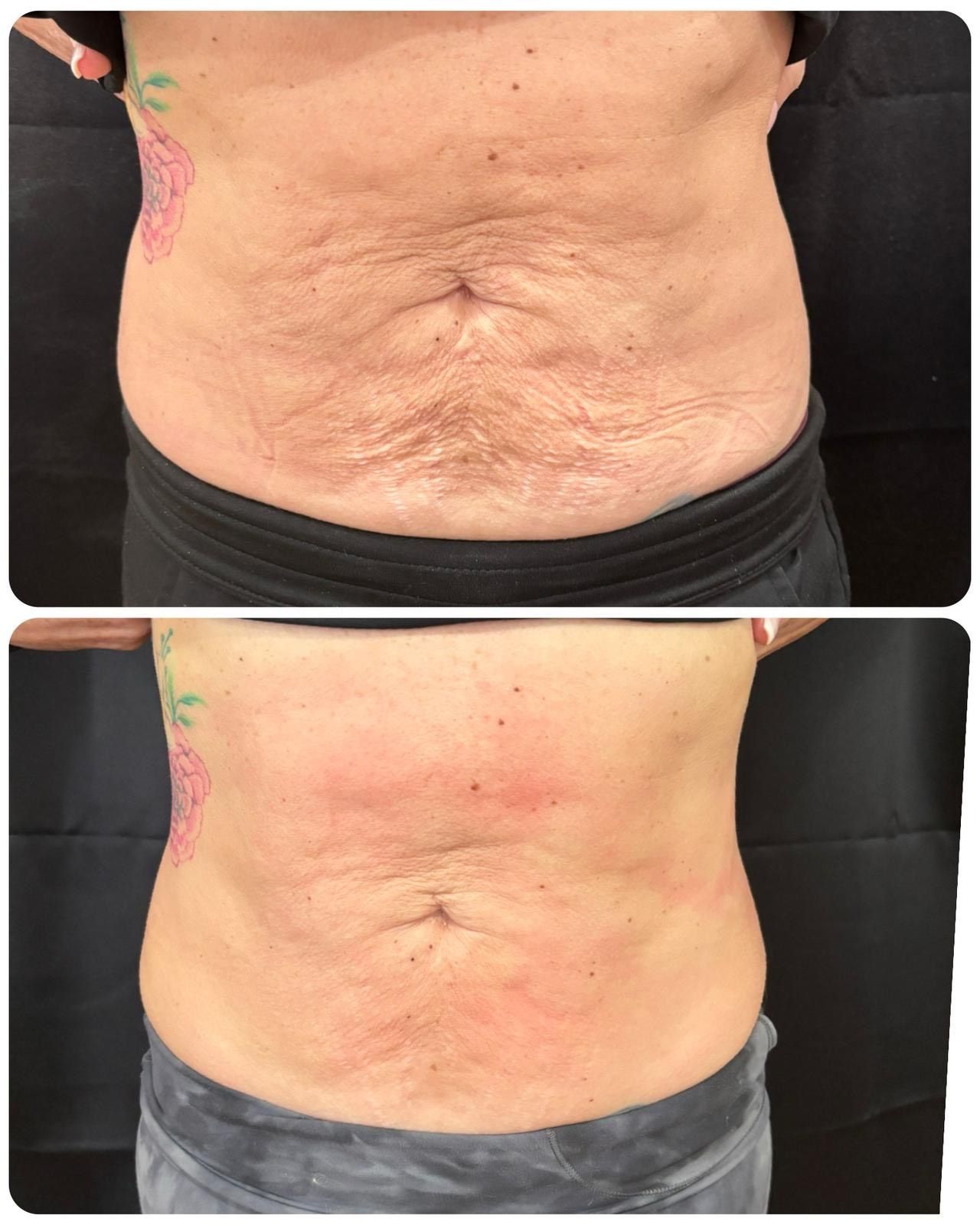 An Artemis T-Shape 2 before and after photo of a woman's belly.