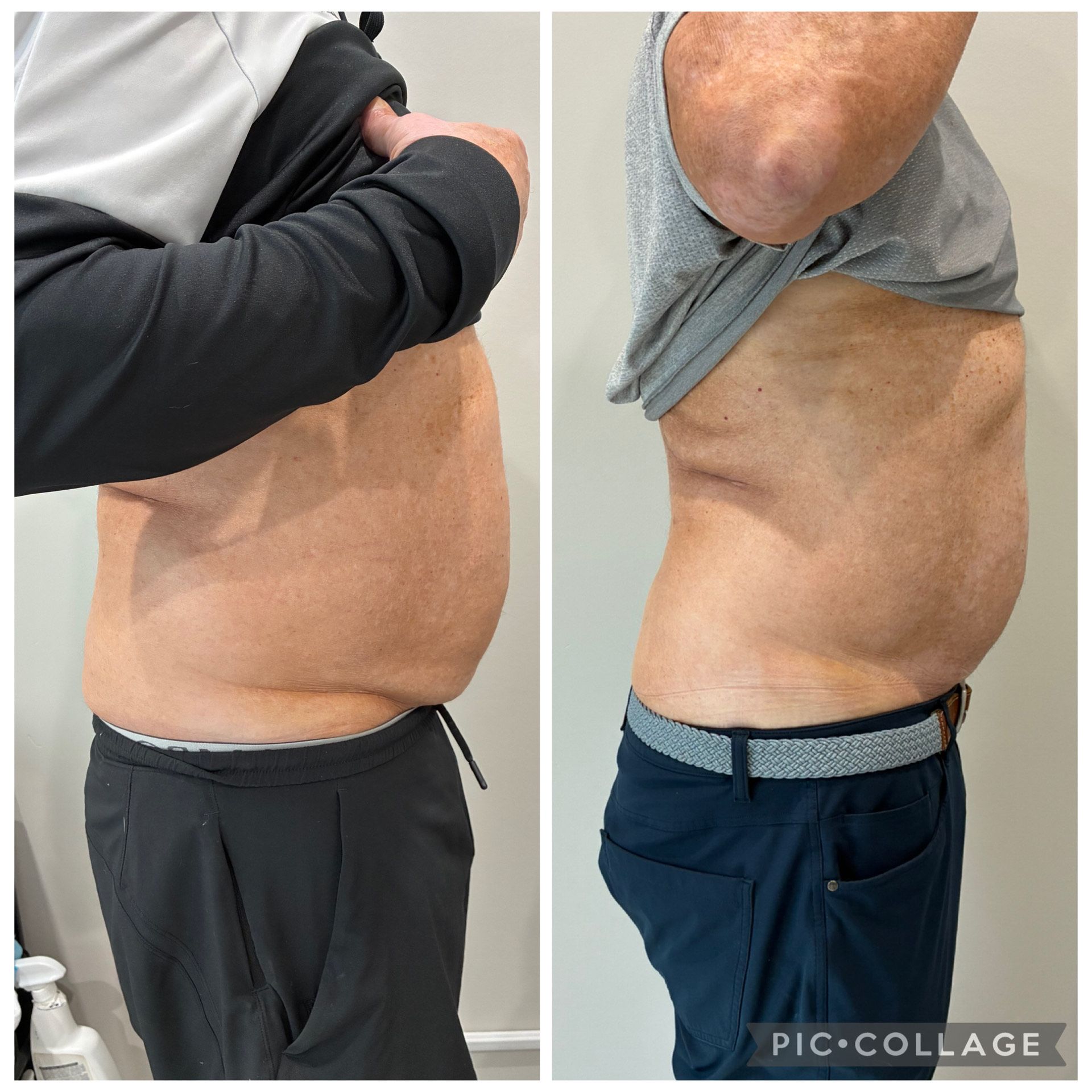 An Artemis T-Shape 2 before and after photo of a man's stomach.