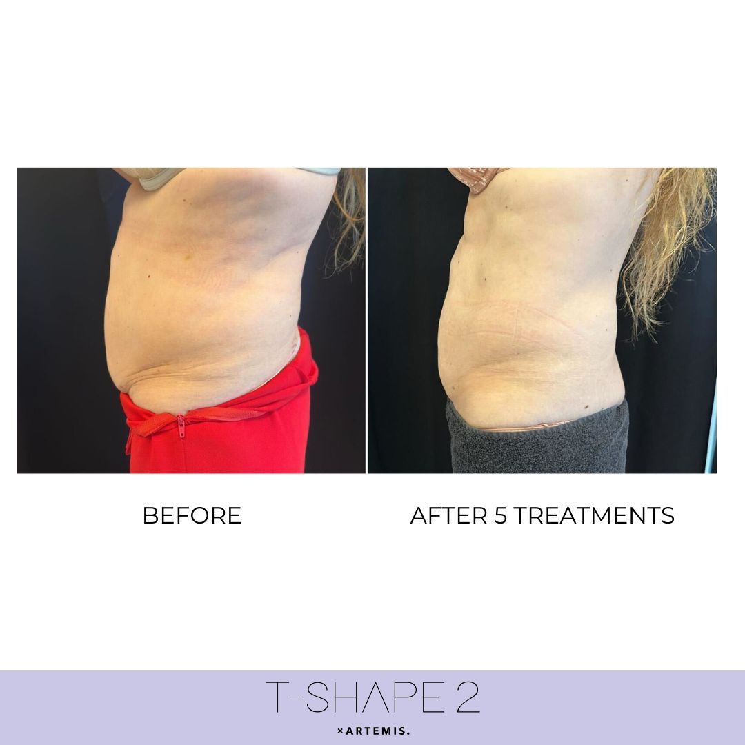 An Artemis T-Shape 2 before and after of a woman's belly.