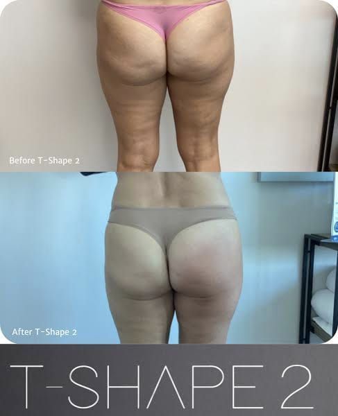 An Artemis T-Shape 2 before and after of a woman's legs and glutes.