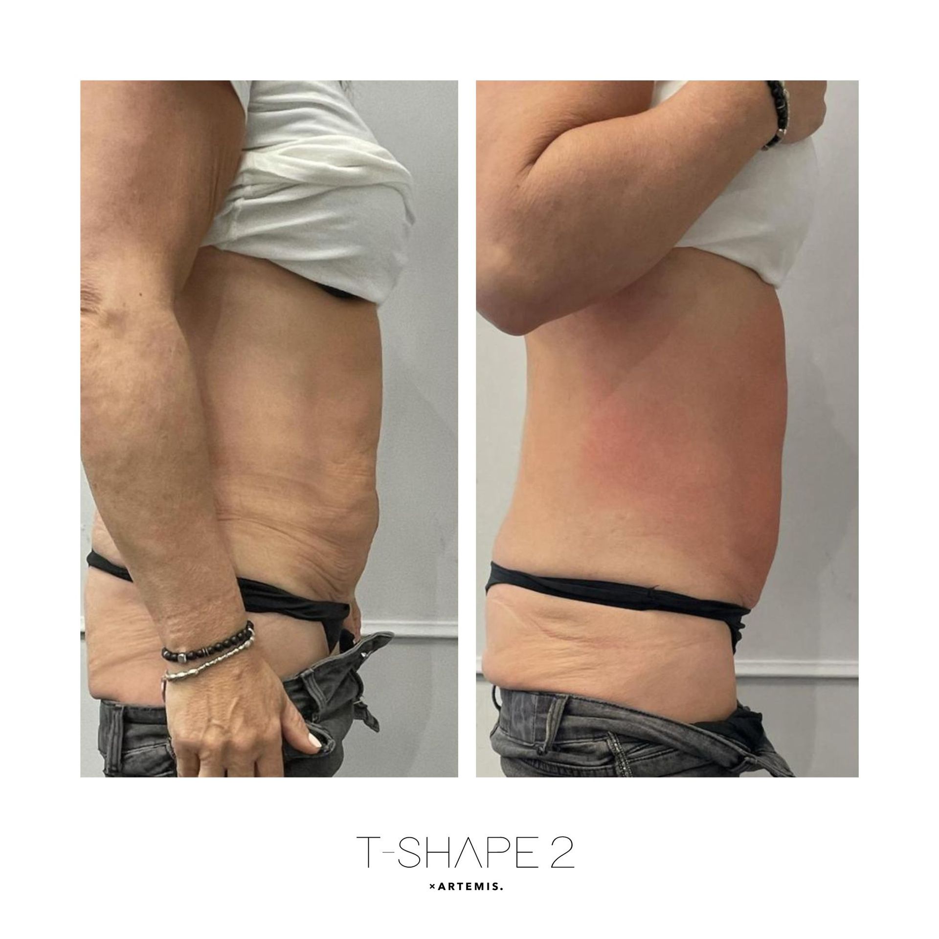 An Artemis T-Shape 2 before and after of a man's stomach.