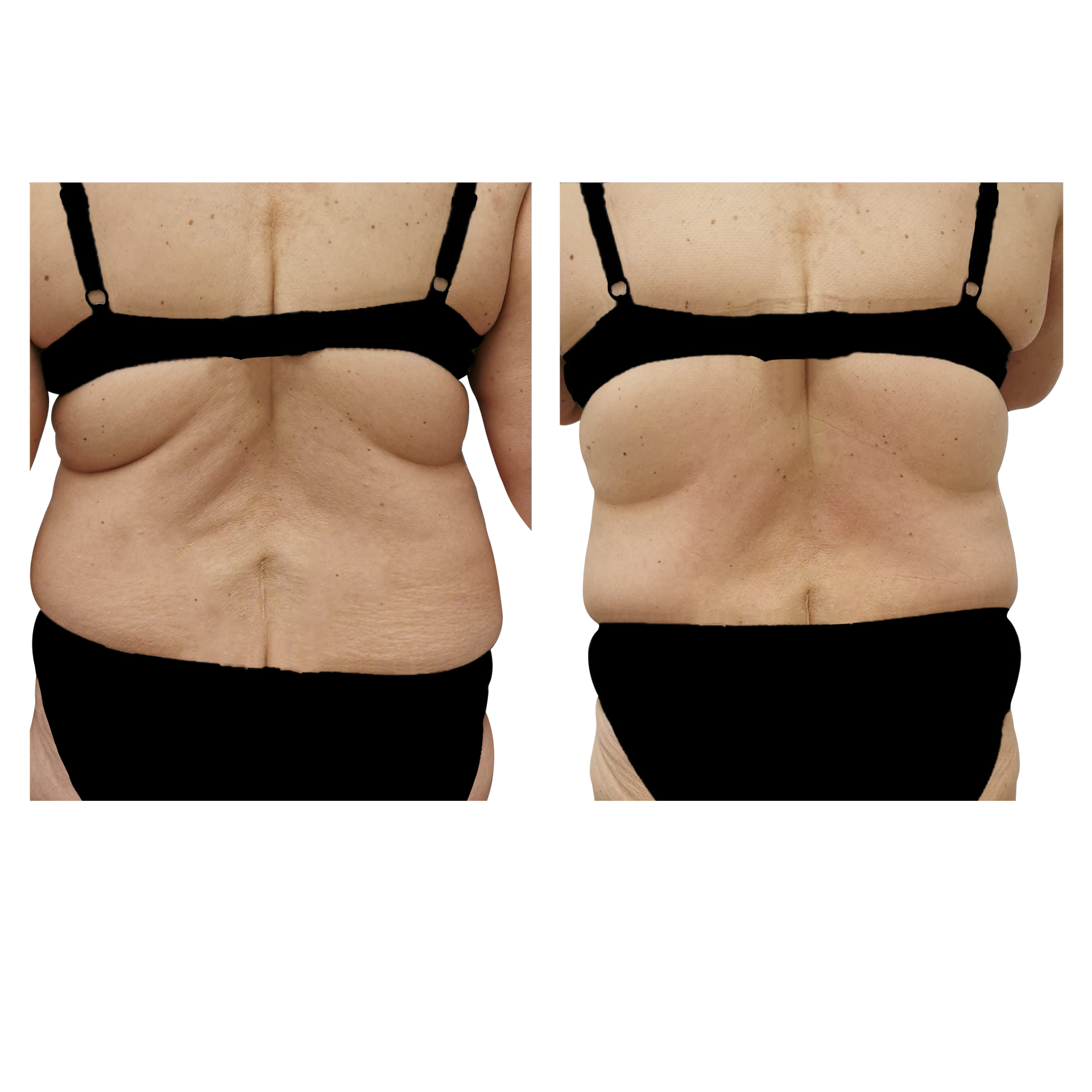 An Artemis T-Shape 2 before and after of a woman's back.