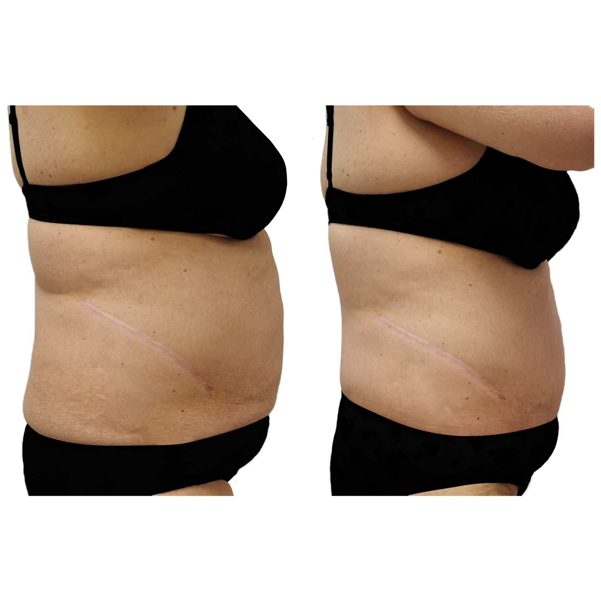 An Artemis T-Shape 2 before and after of a woman's belly.