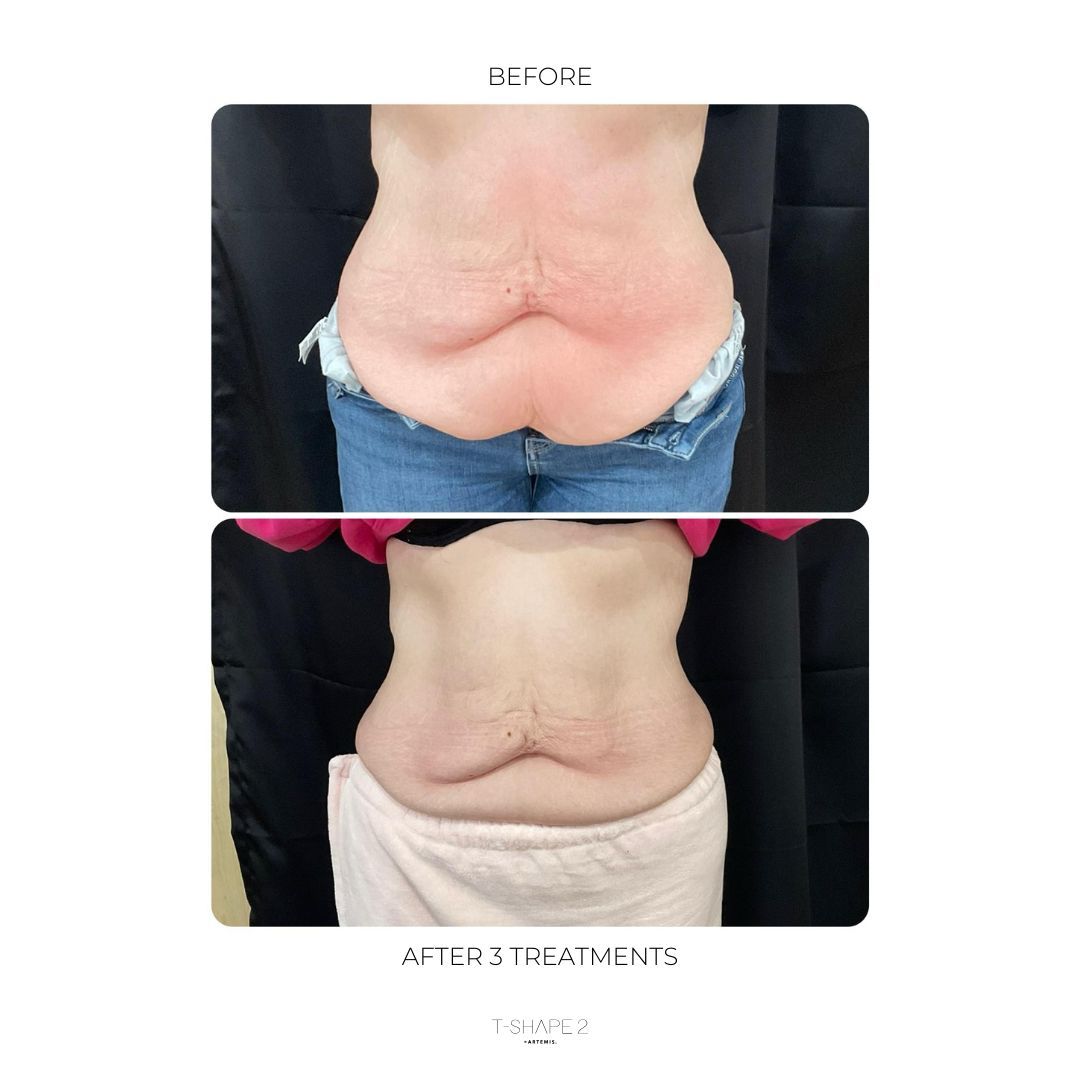 An Artemis T-Shape 2 before and after of a woman's belly.