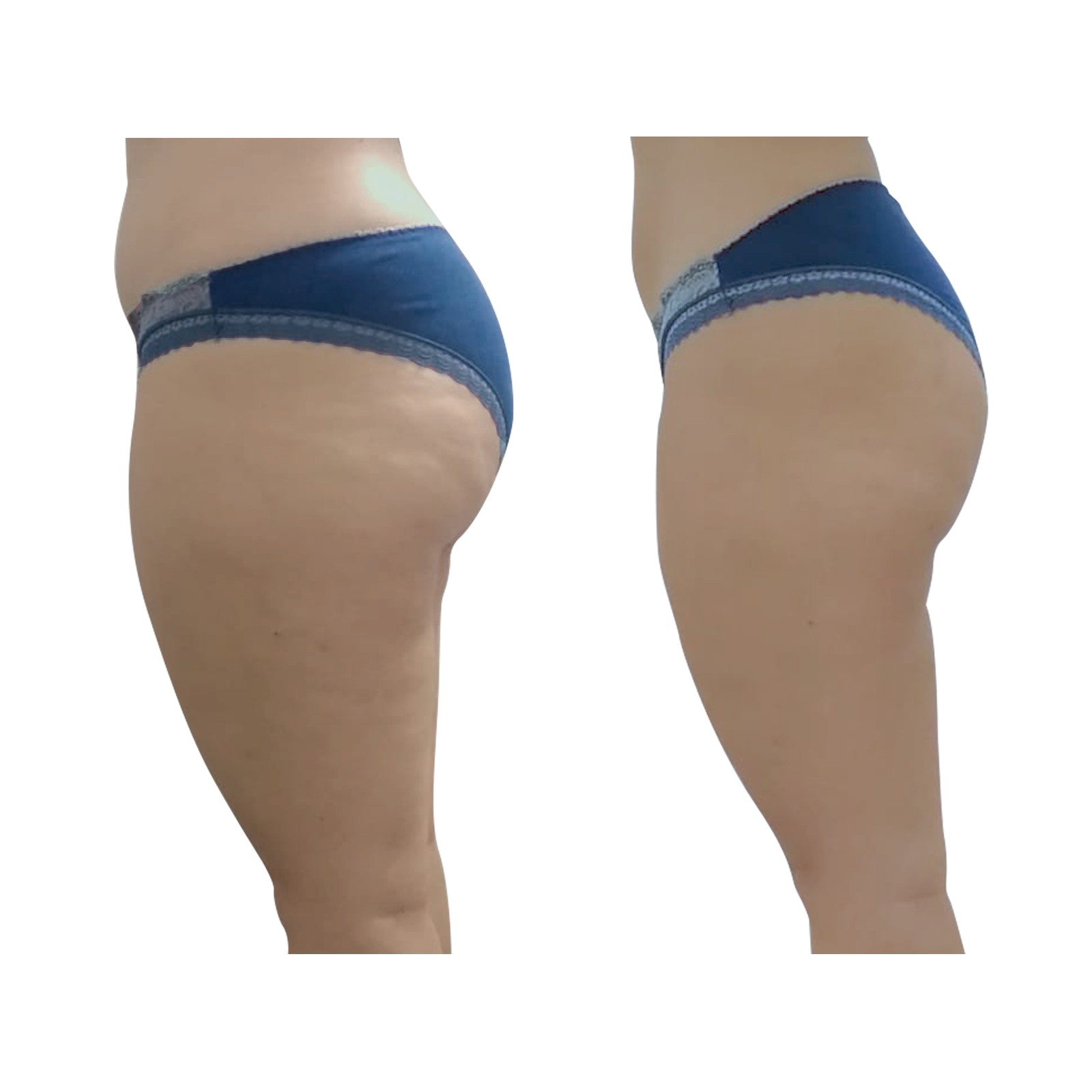 An Artemis T-Shape 2 before and after of a woman's legs.