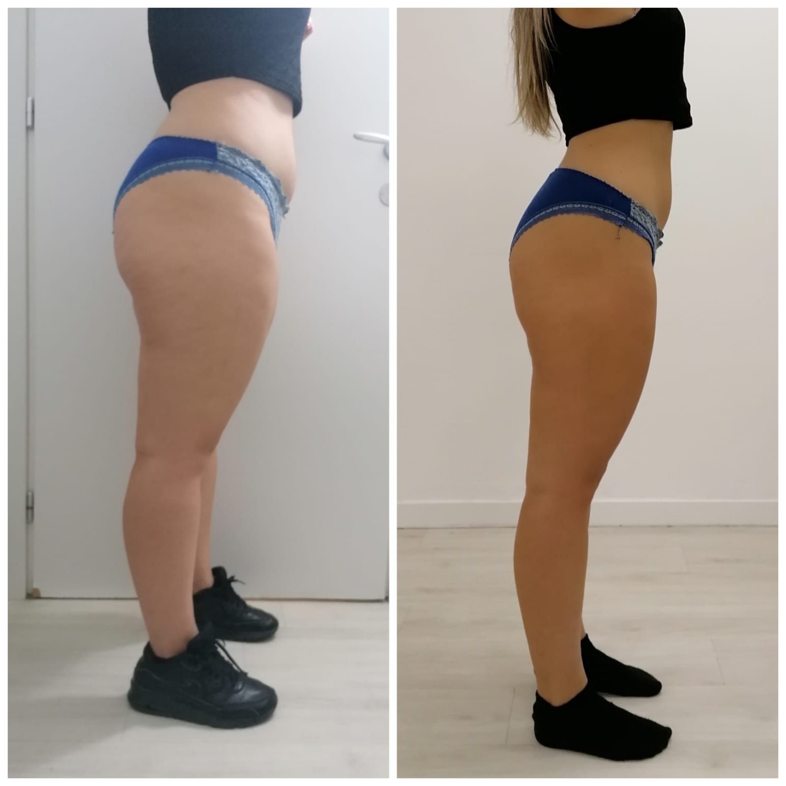 An Artemis T-Shape 2 before and after of a woman's belly and legs.