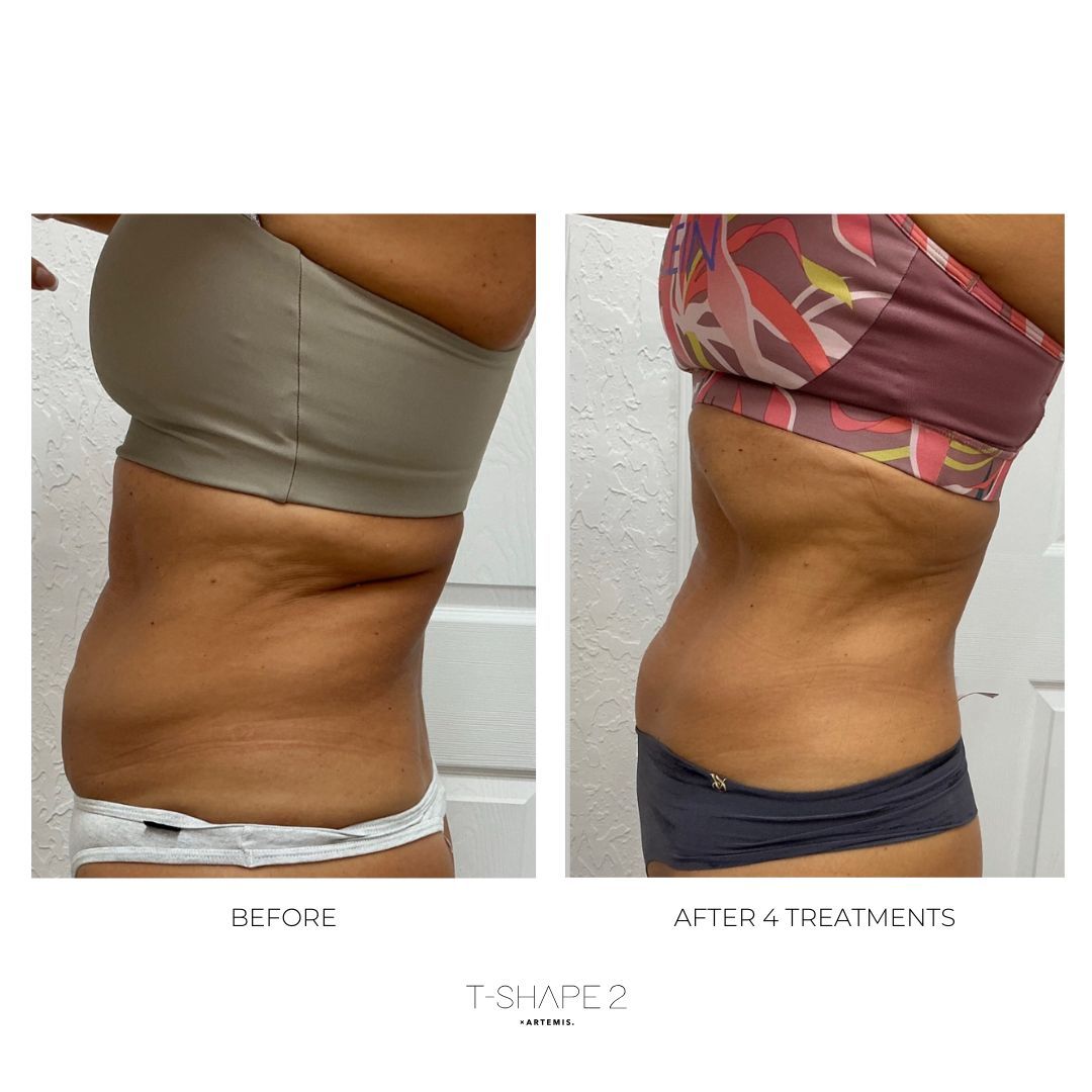 An Artemis T-Shape 2 before and after of a woman's belly.
