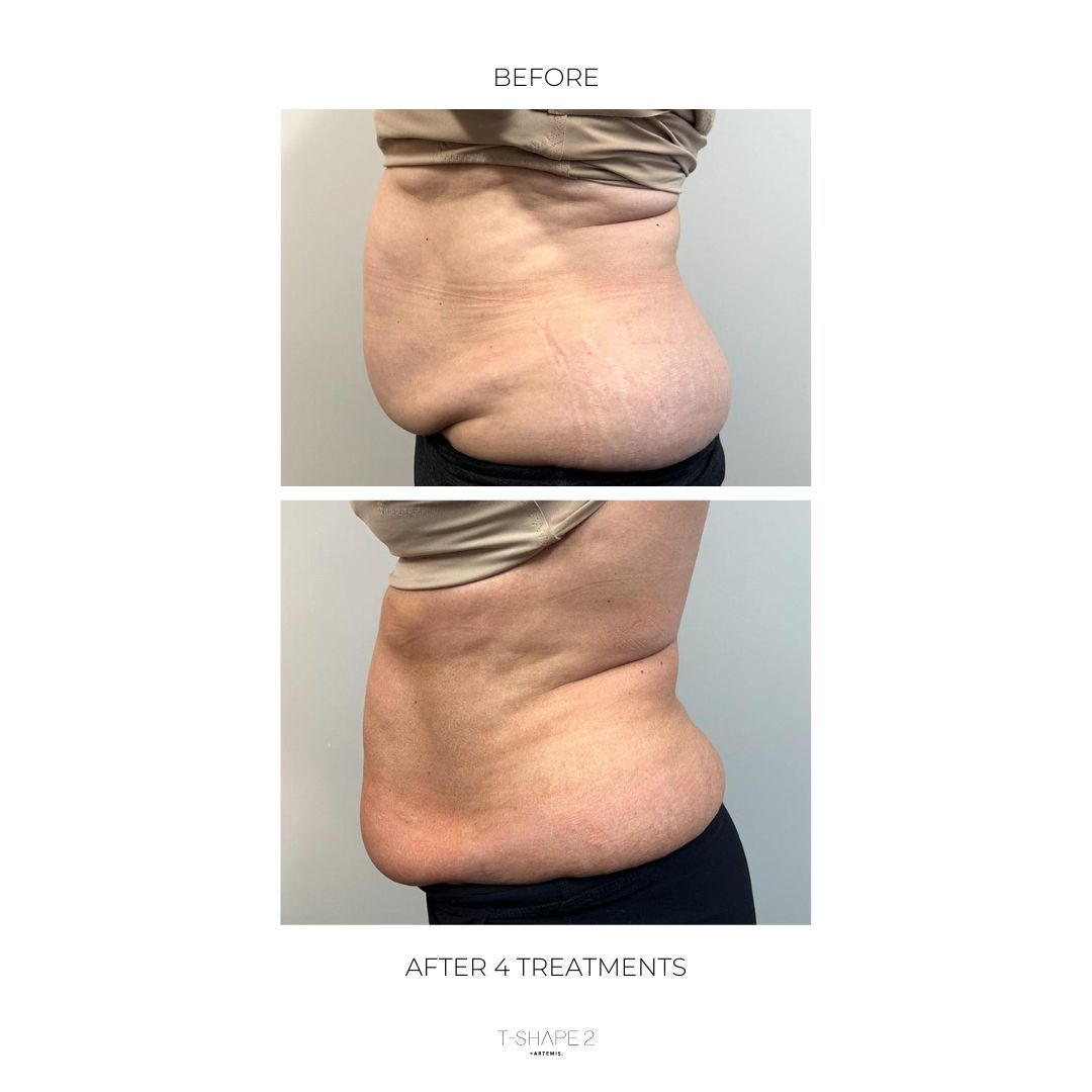 An Artemis T-Shape 2 before and after of a woman's belly.