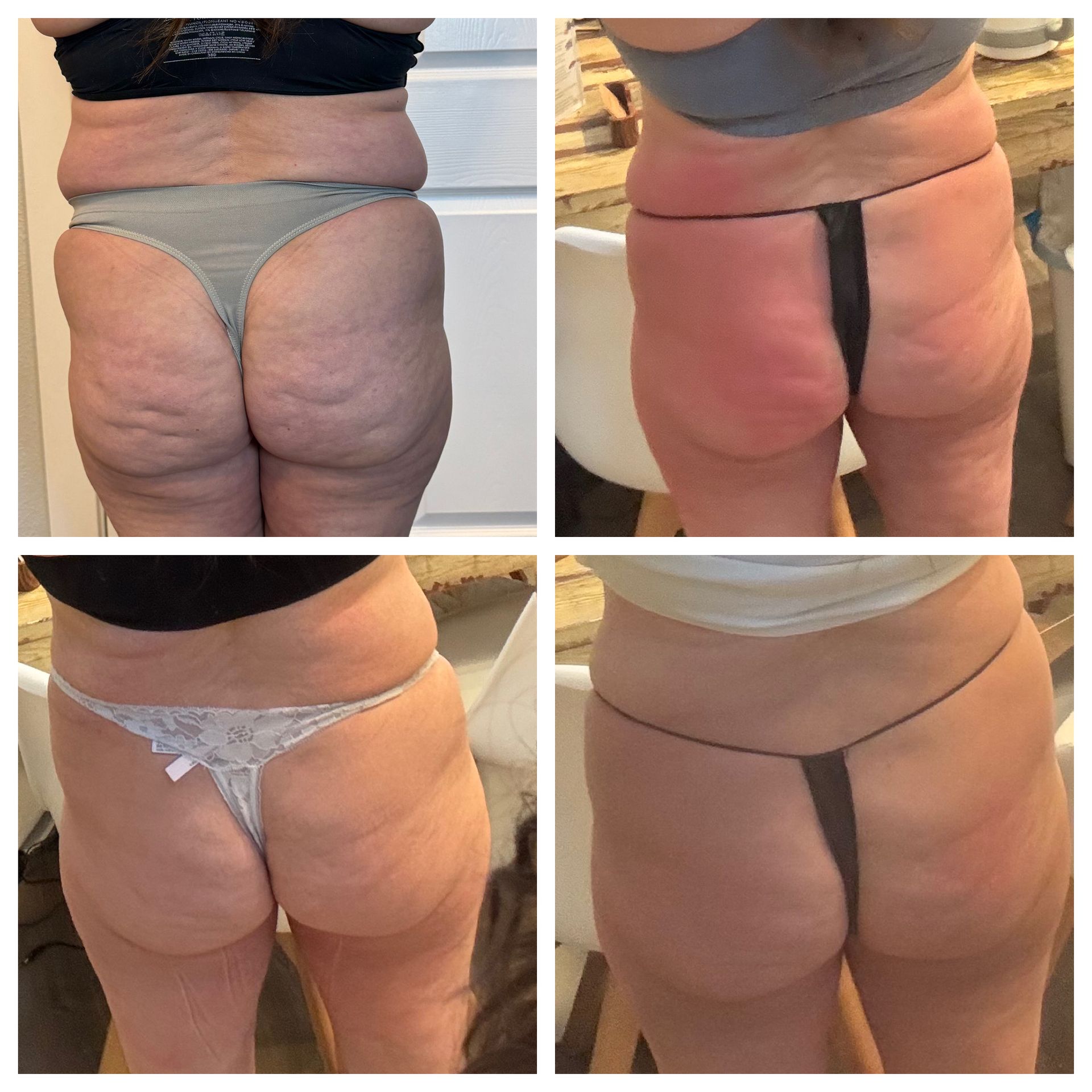 An Artemis T-Shape 2 before and after of a woman's glutes.
