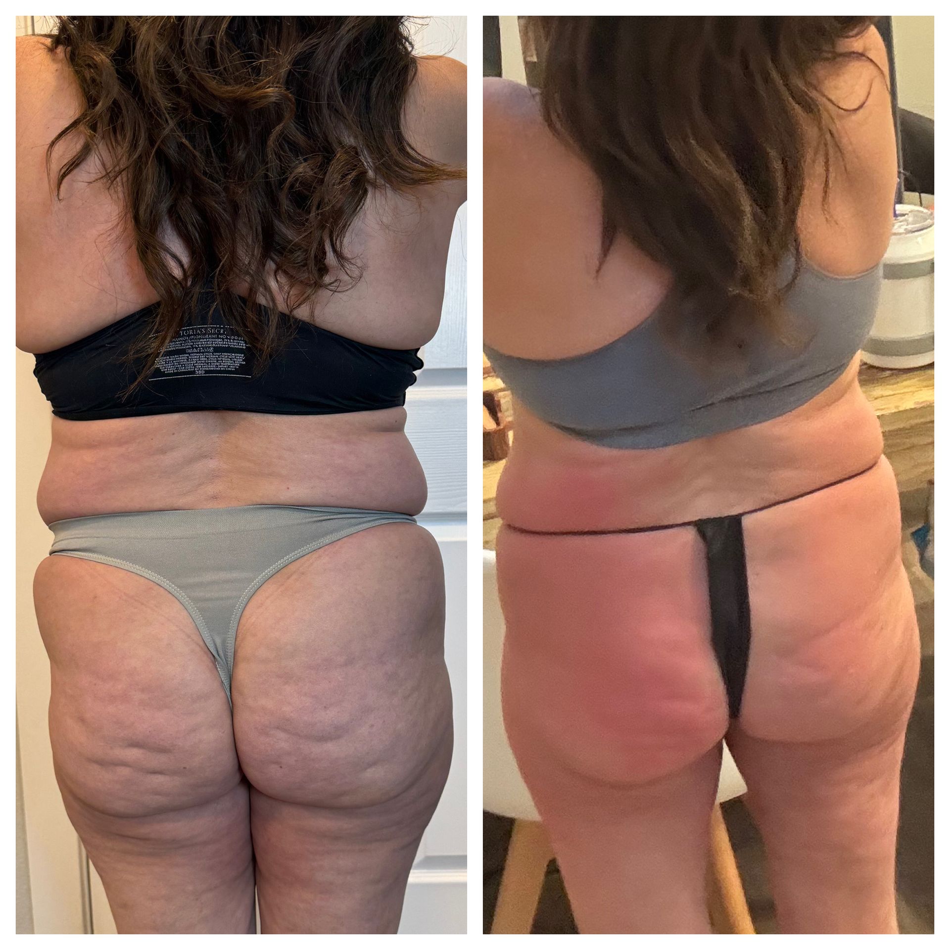 An Artemis T-Shape 2 before and after of a woman's glutes.
