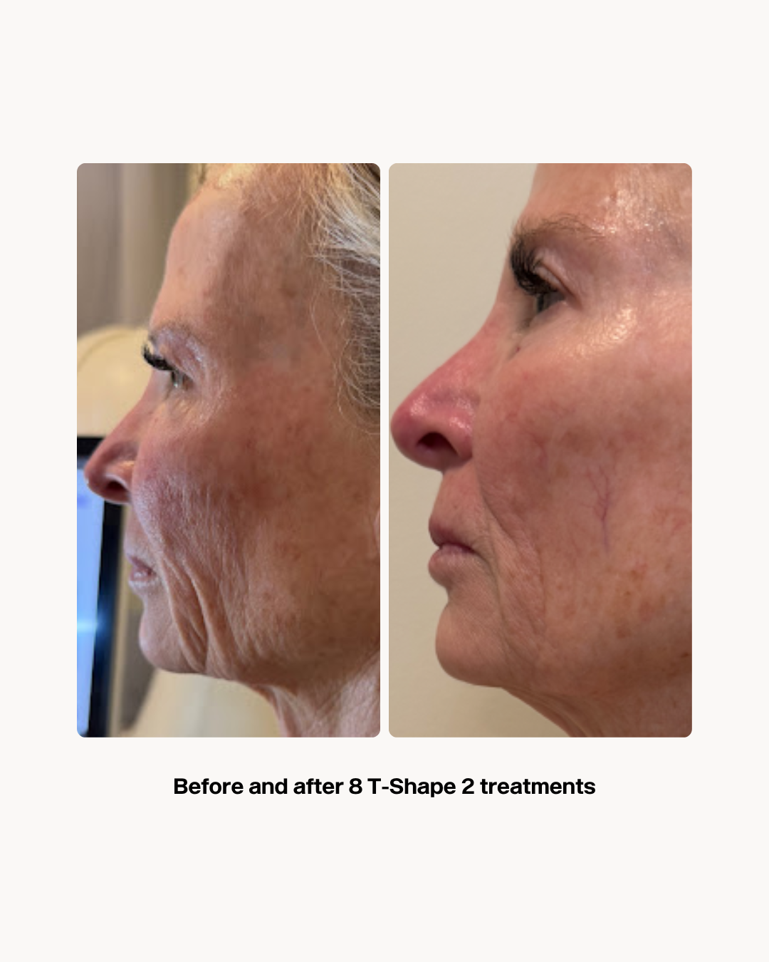 An Artemis T-Shape 2 before and after photo of a woman's face.