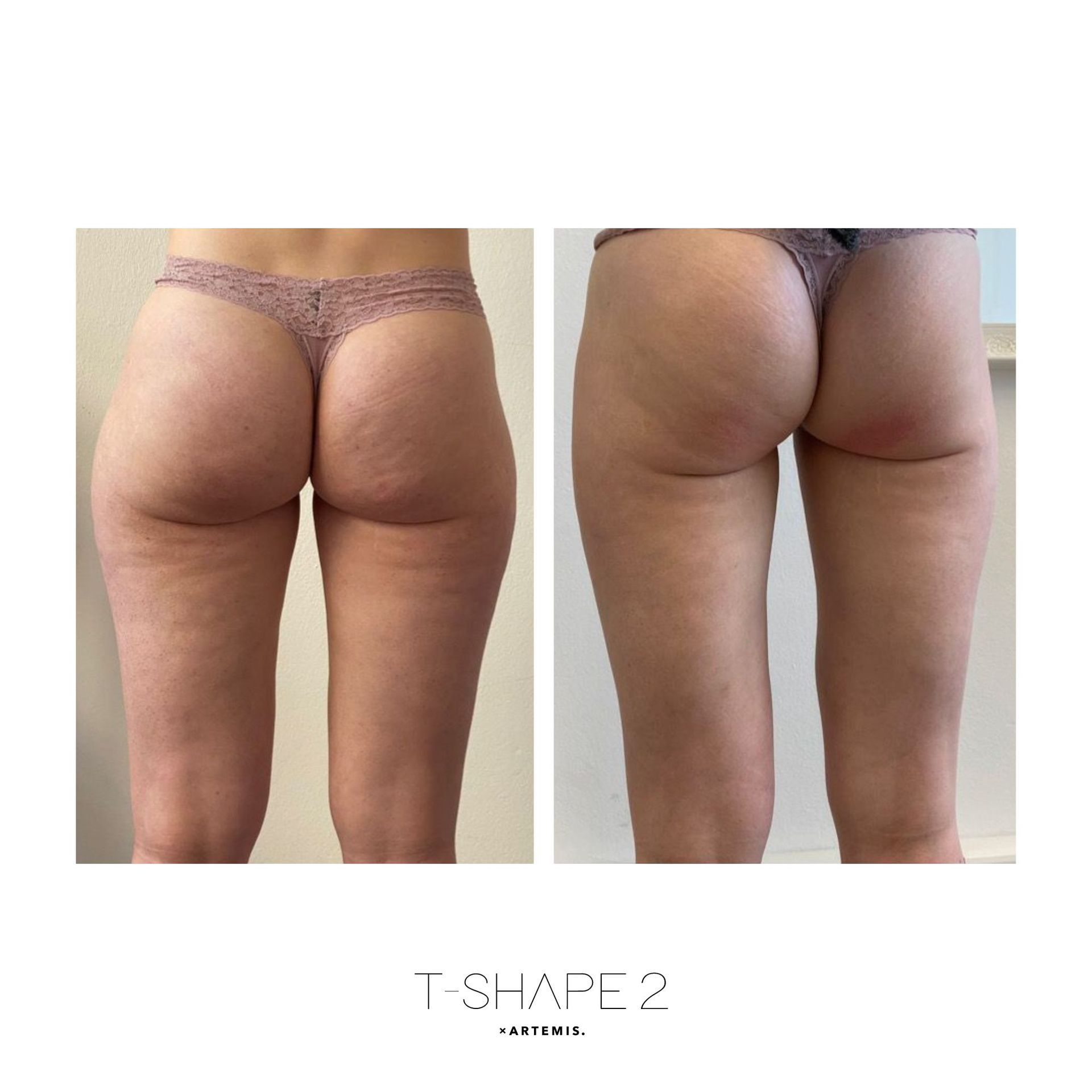 An Artemis T-Shape 2 before and after of a woman's glutes.