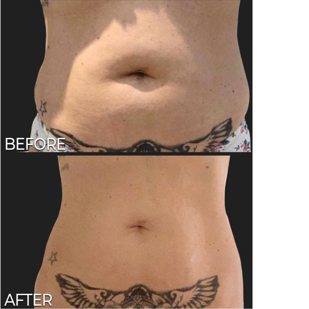 An Artemis T-Shape 2 before and after of a woman's belly.