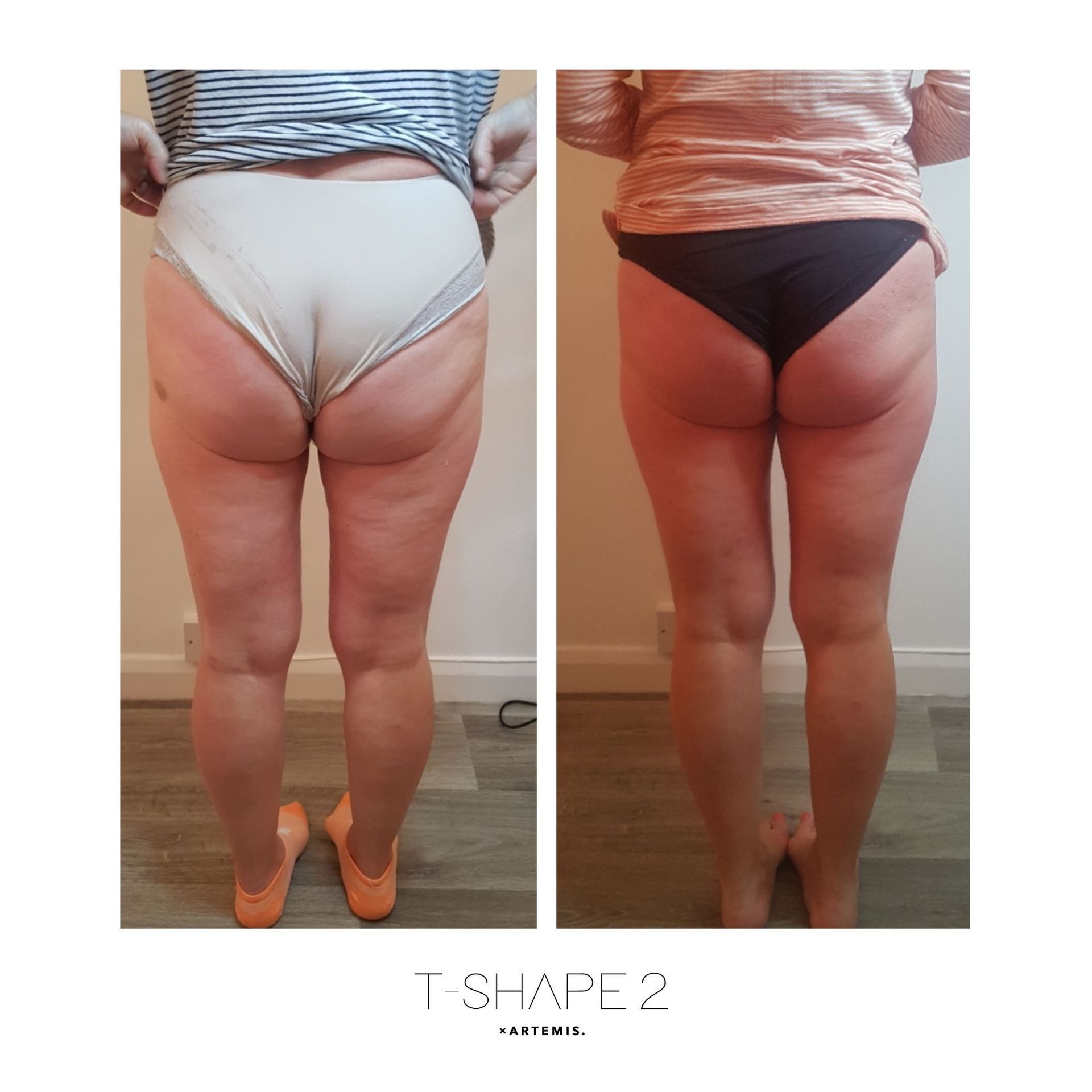 An Artemis T-Shape 2 before and after of a woman's glutes and legs.