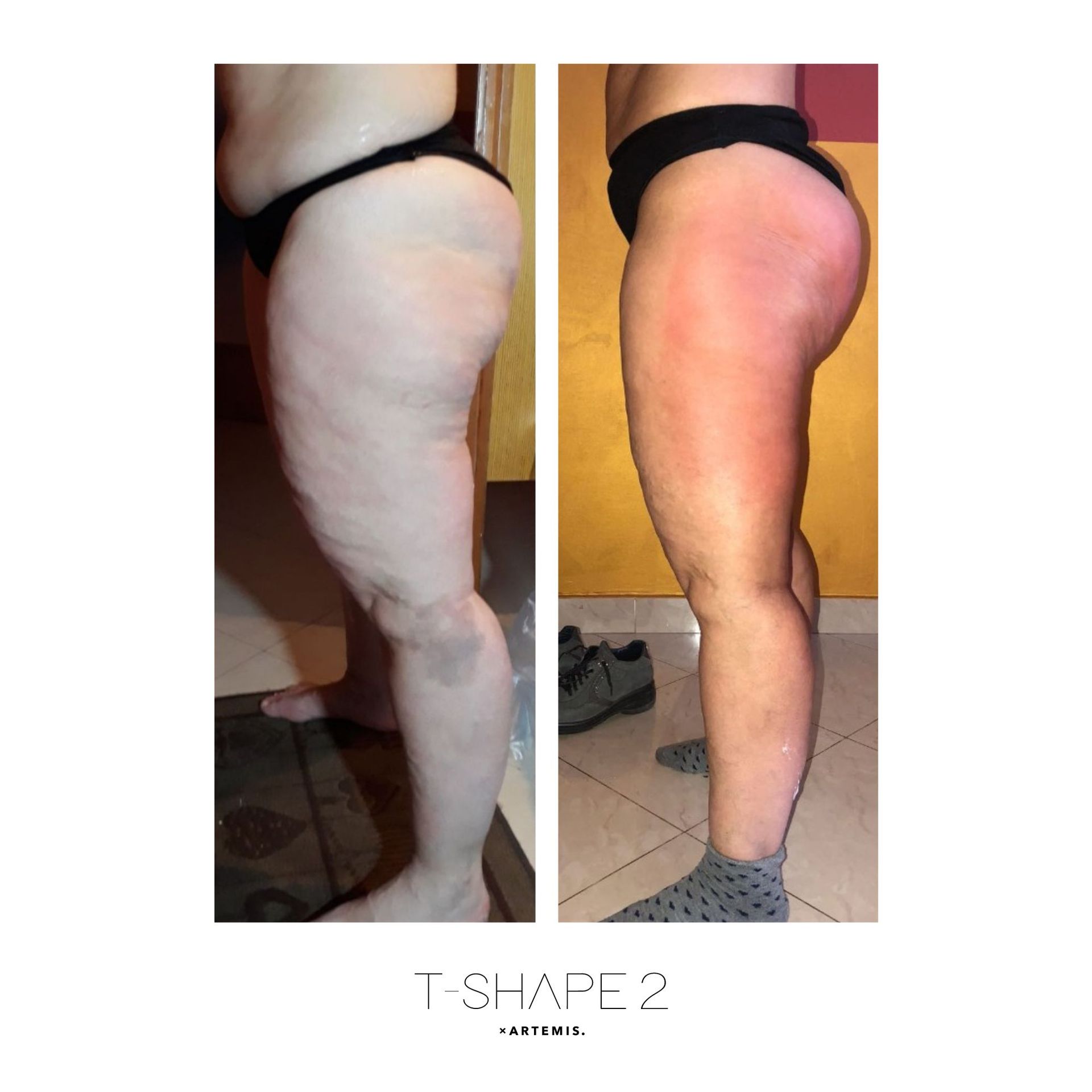 An Artemis T-Shape 2 before and after of a woman's legs.