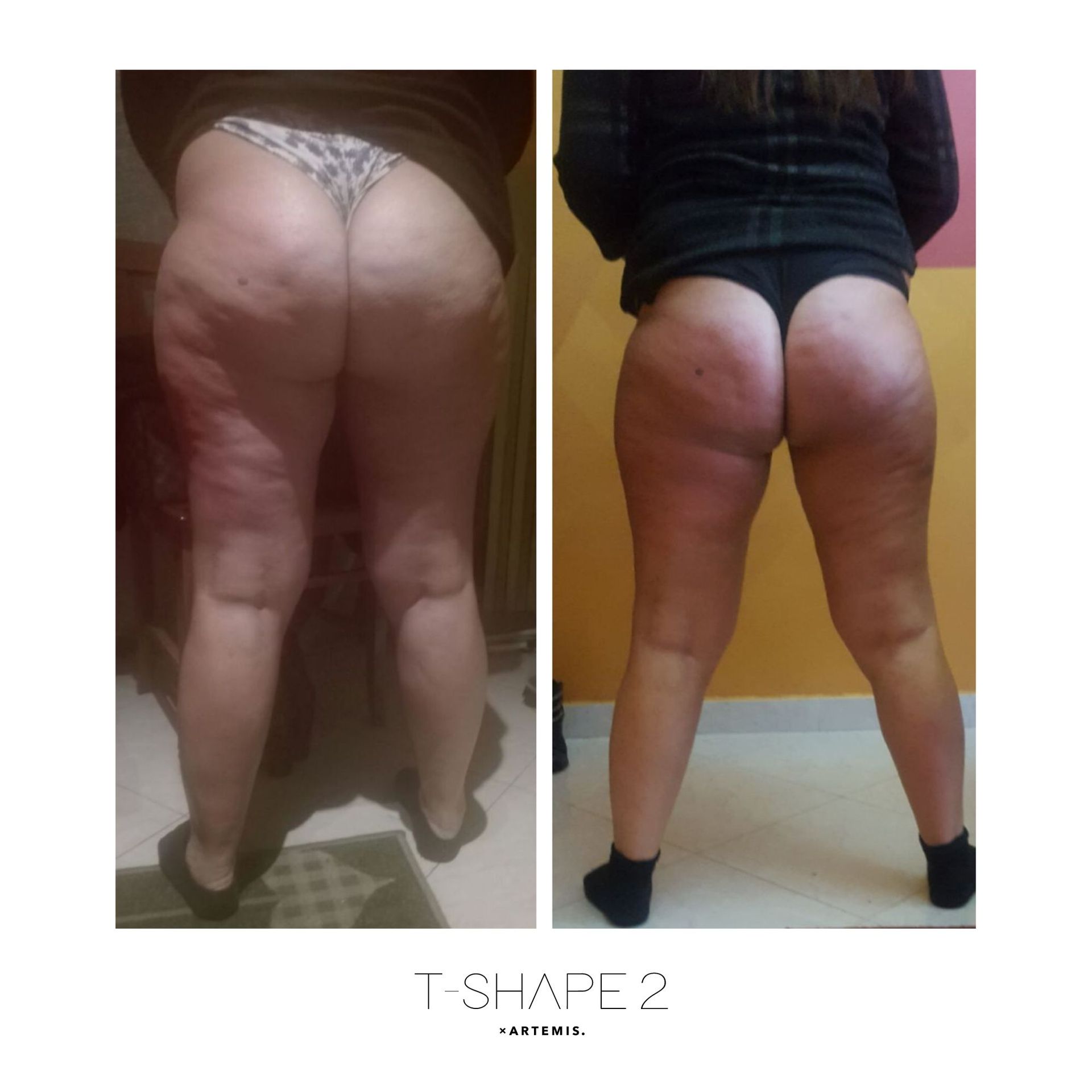 An Artemis T-Shape 2 before and after of a woman's legs.