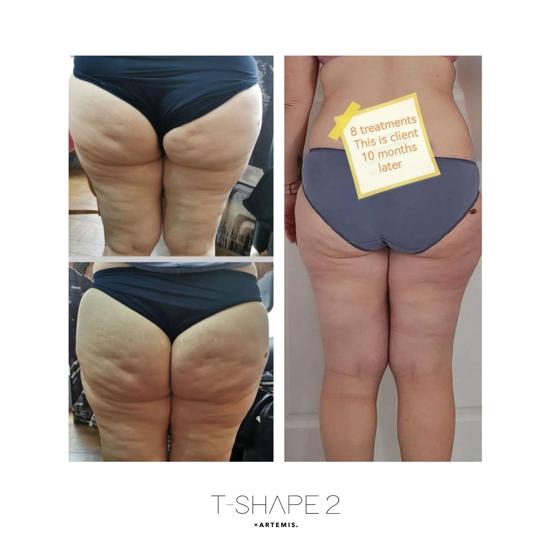 An Artemis T-Shape 2 before and after of a woman's buttocks and legs.
