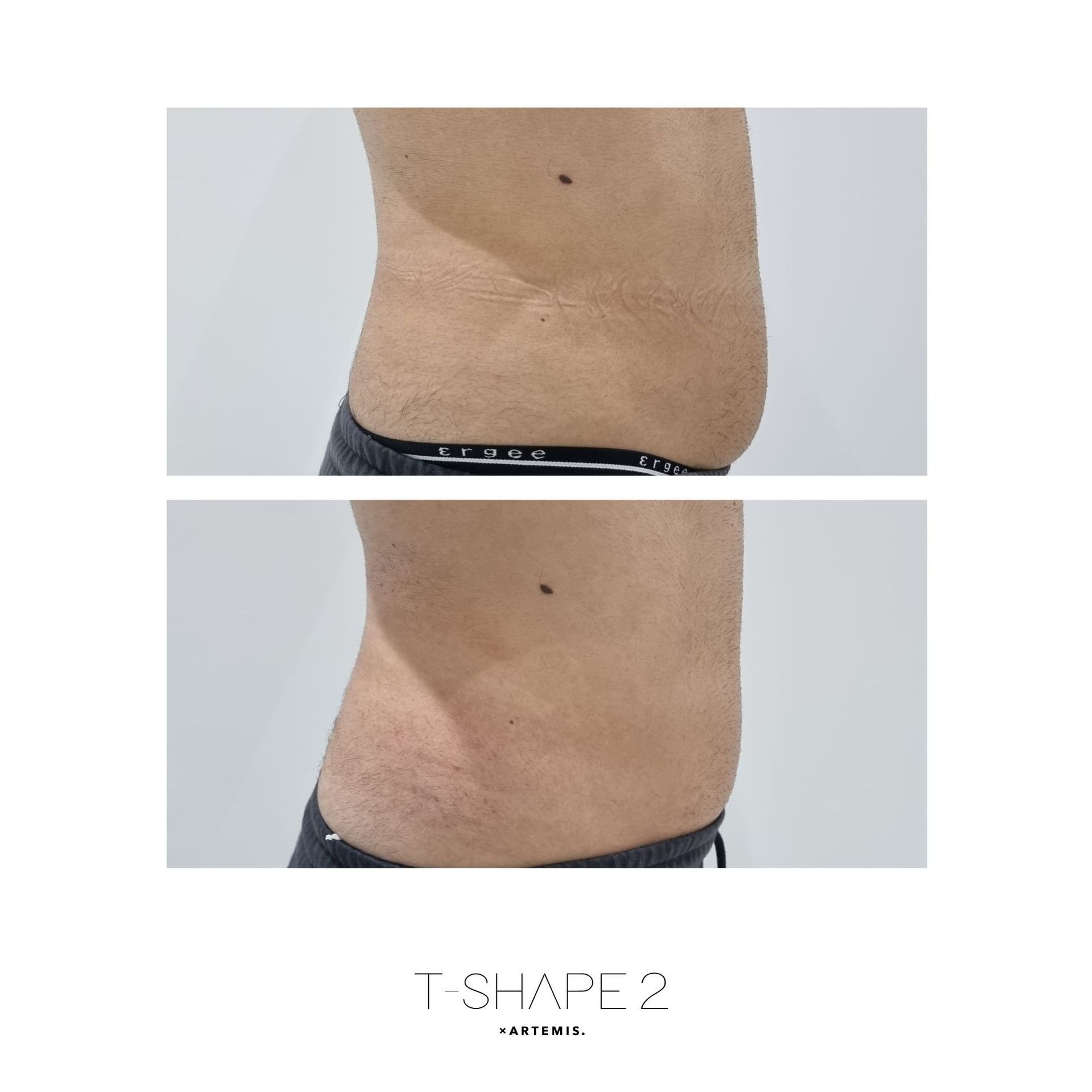 An Artemis T-Shape 2 before and after of a man's belly.