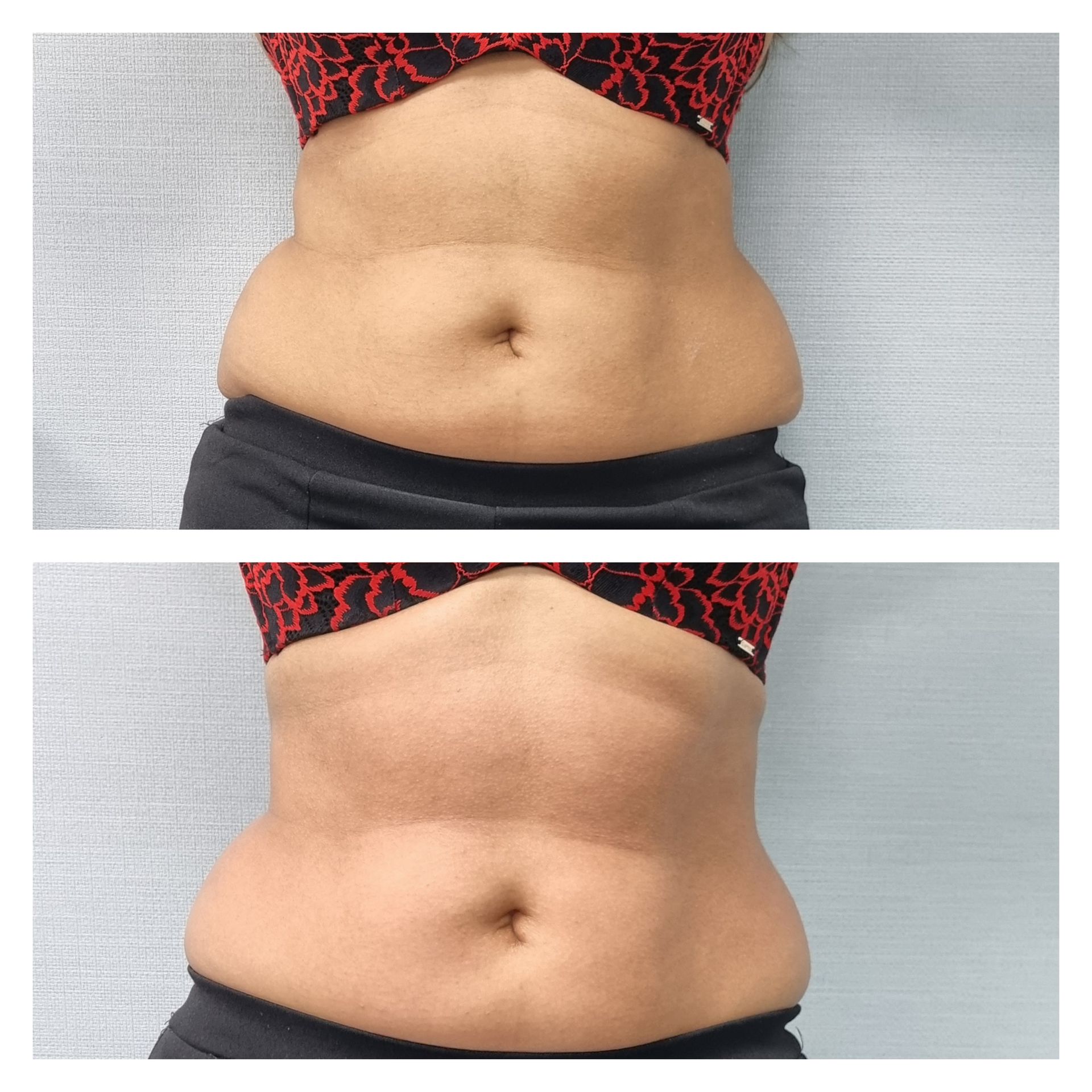 An Artemis T-Shape 2 before and after of a woman's belly.