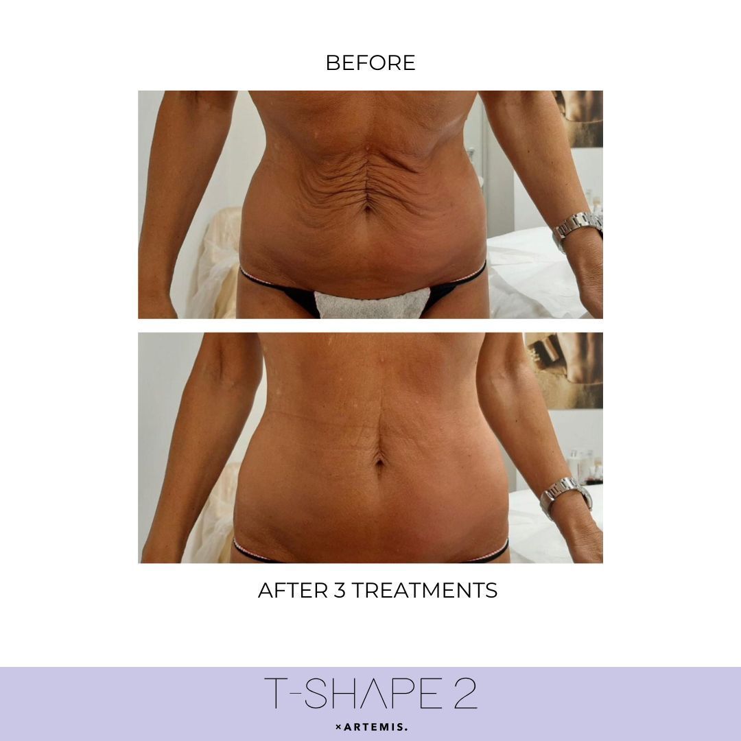 An Artemis T-Shape 2 before and after of a woman's belly.