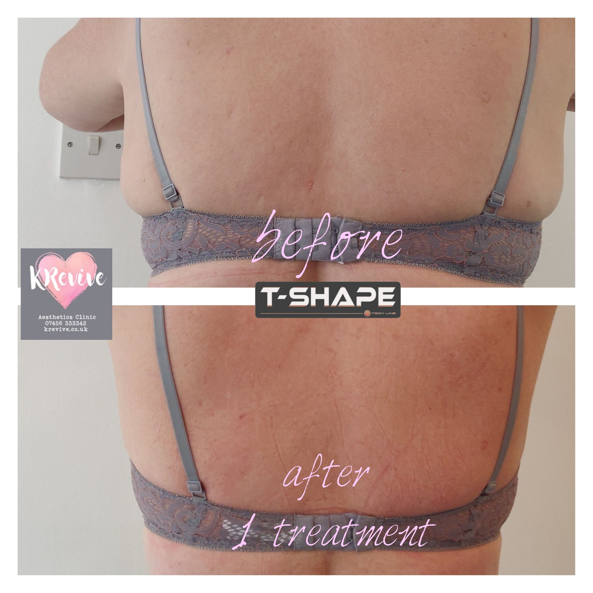 An Artemis T-Shape 2 before and after of a woman's back bra fat.