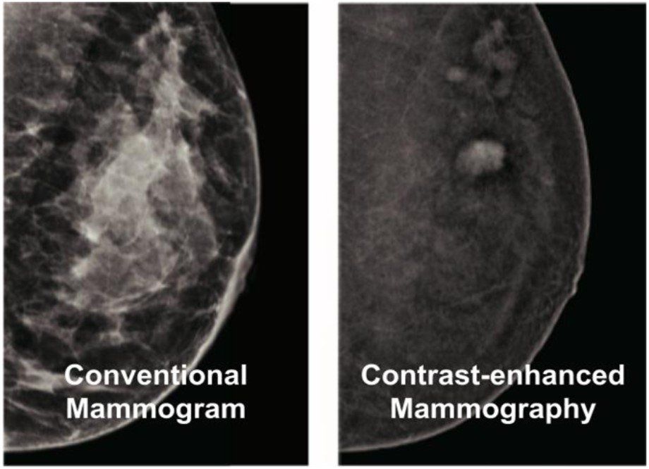 Comparison of Conventional Mammogram and Contrast-enhanced Mammography