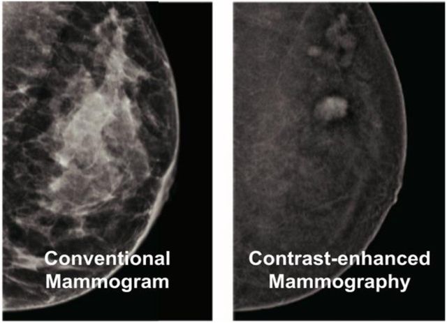 Mammograms, Ultrasounds and MRIs: What's the Difference?