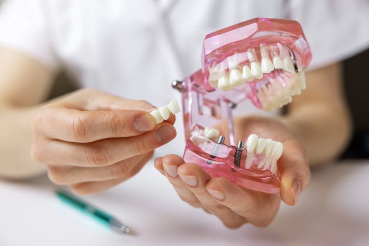 Dentist holding a model of teeth, demonstrating a dental crown.